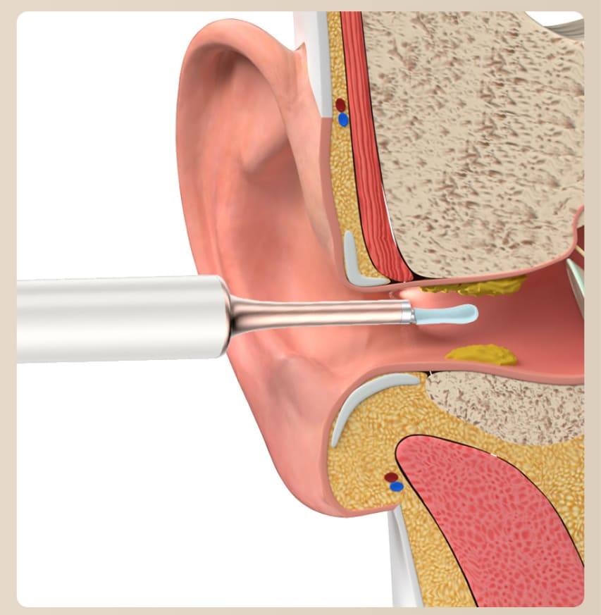 کان صاف کرنے والا earwax ہٹانے والا